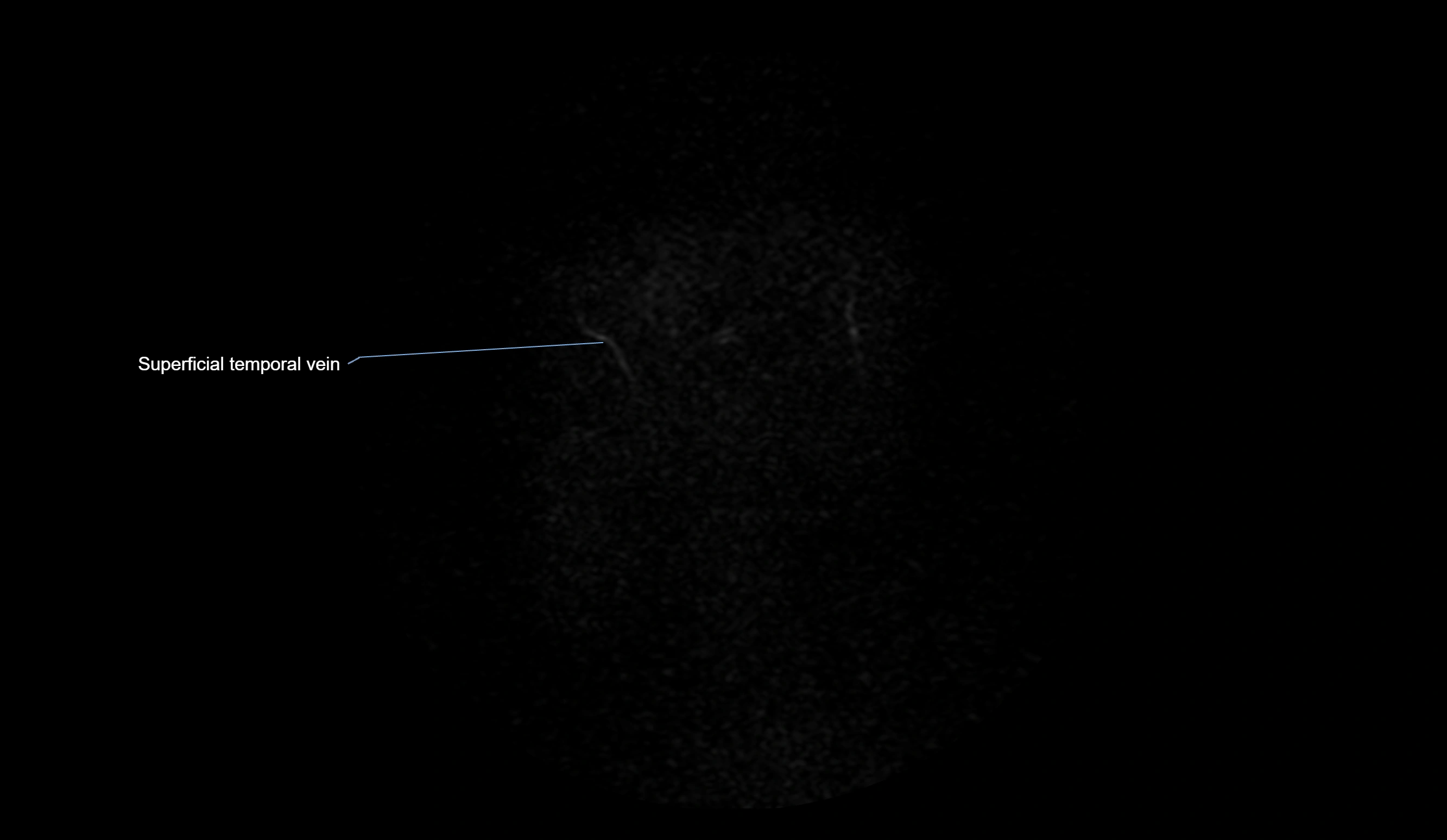 MRV brain sagittal anatomy 3T MRI labelledimages -00078.webp